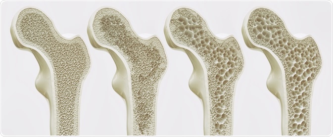 MONOTHERAPY?: Osteoporosis and Osteopenia – Lewis K. Clarke M.D., PhD